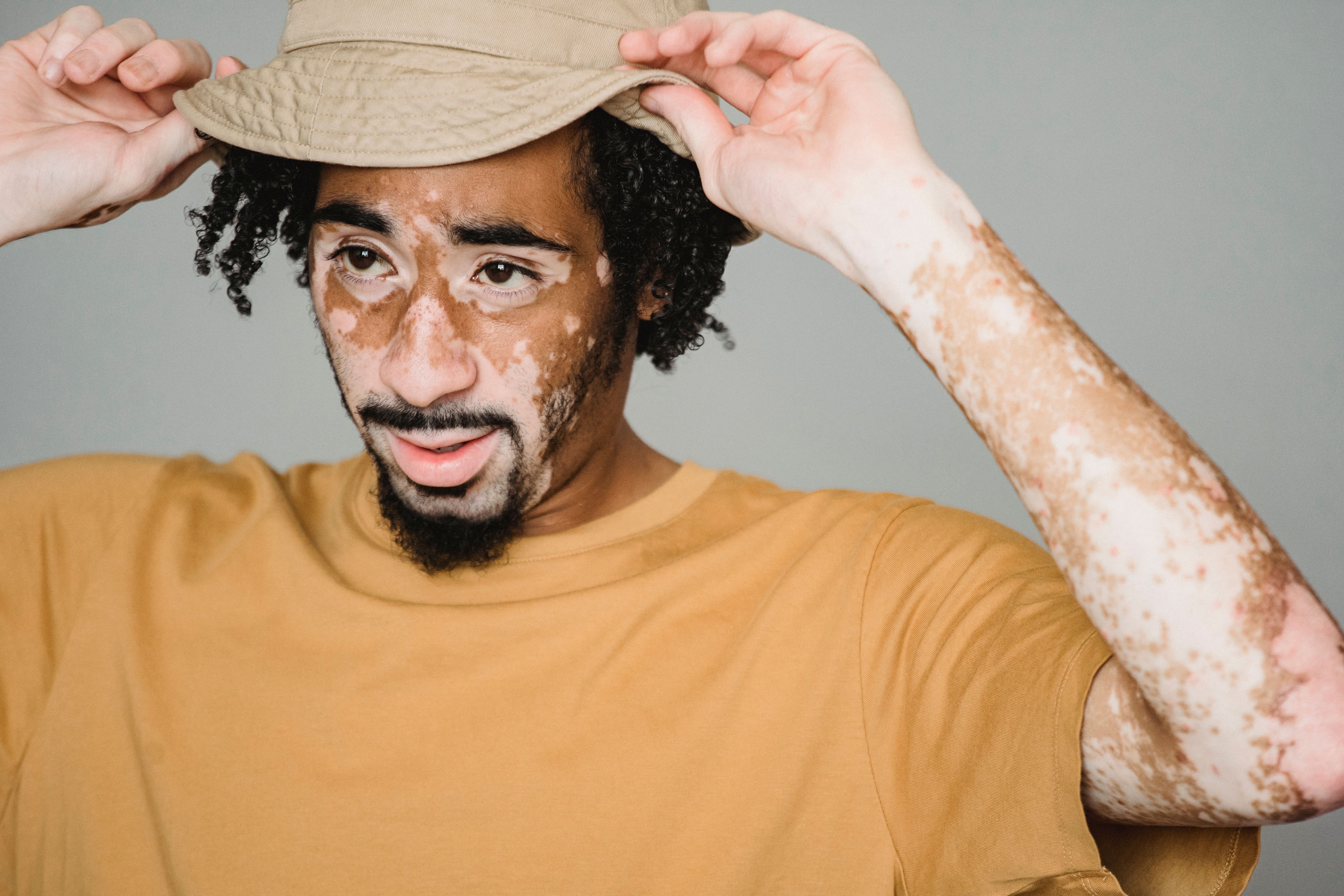 Skin Discoloration: Causes of Dark Spots, Redness & More cover