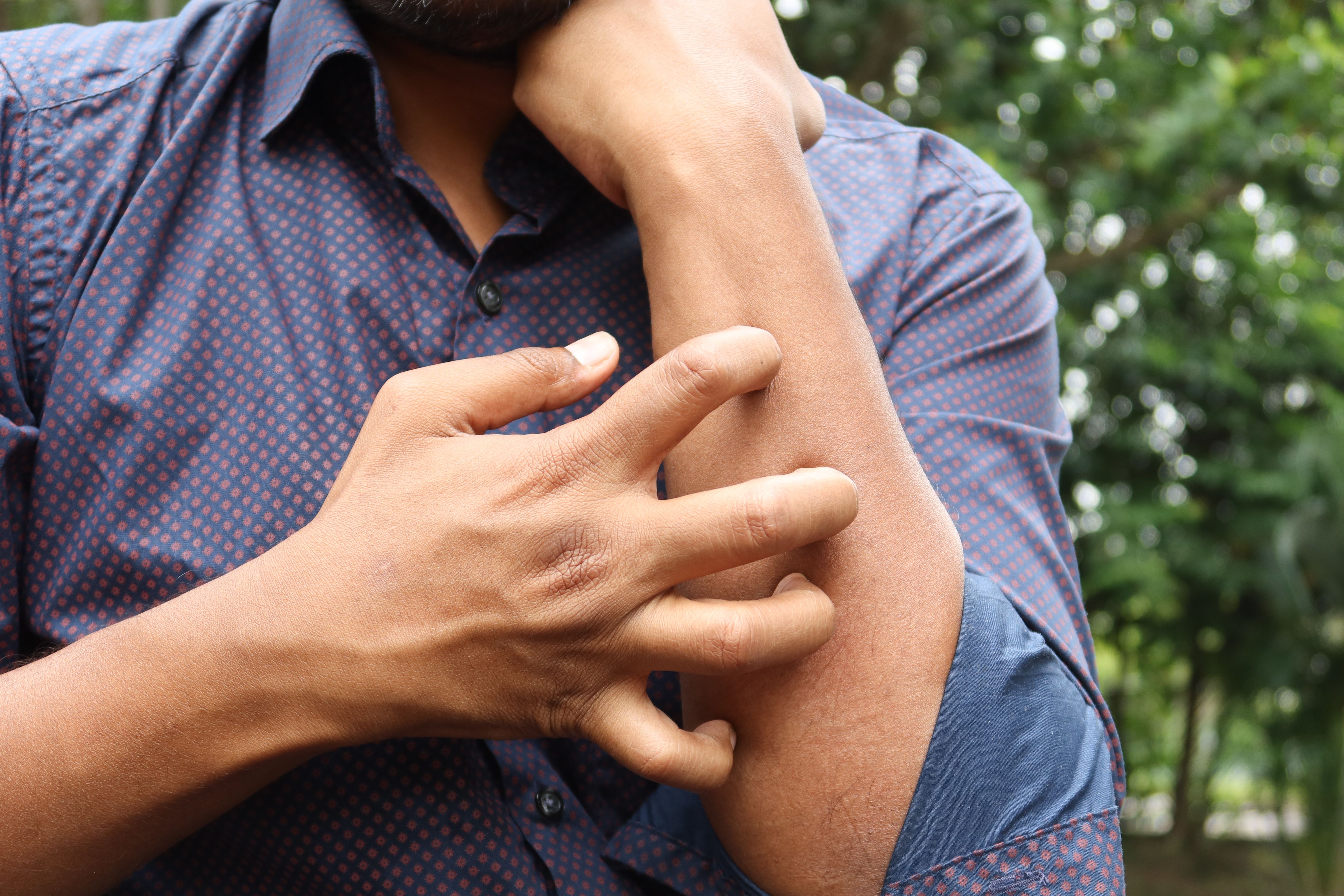Common Psoriasis Triggers: What Research Says About Flare-Ups cover